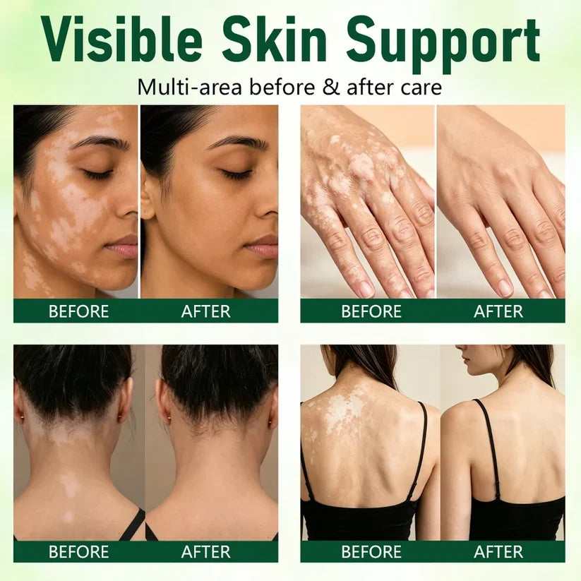 Herbal Vitiligo Cream The White Looks Less Stark in 7 Days.