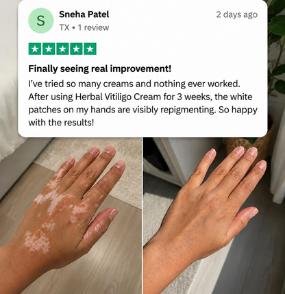 Herbal Vitiligo Cream The White Looks Less Stark in 7 Days.