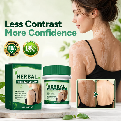Herbal Vitiligo Cream The White Looks Less Stark in 7 Days.
